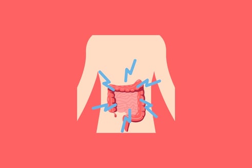 bowel cancer stages
